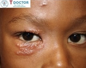 Zona thần kinh là bệnh lý có nguyên nhân do cùng loại virus của bệnh thủy đậu gây ra có tên là varicella zoster virus VZV. Bệnh thường làm cho người mắc có các triệu chứng mệt mỏi, khó chịu, sốt nhẹ và nổi các mụn nước nhỏ. 
